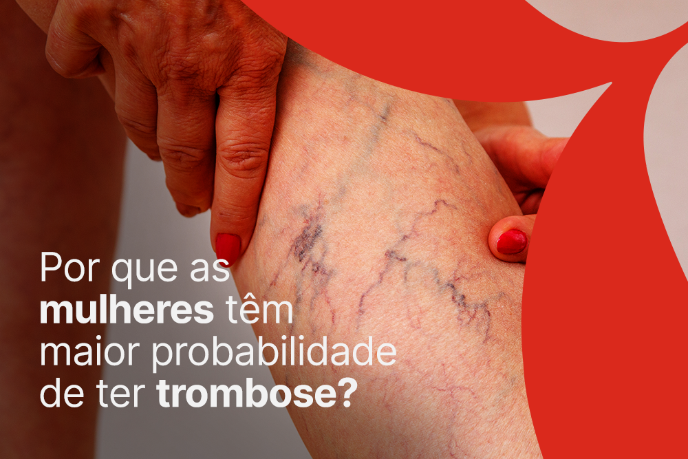 Por que as mulheres têm maior probabilidade de ter trombose?